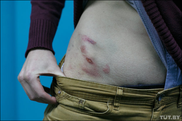 TUT.BY подсчитал: За последние 10 лет журналистов в Беларуси избивали больше 30&nbsp;раз